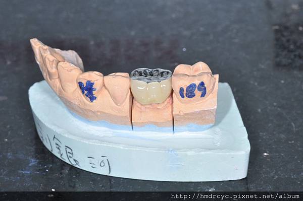 [假牙牙套] 咬合面金屬假牙設計 高雄牙醫 假牙牙套推薦