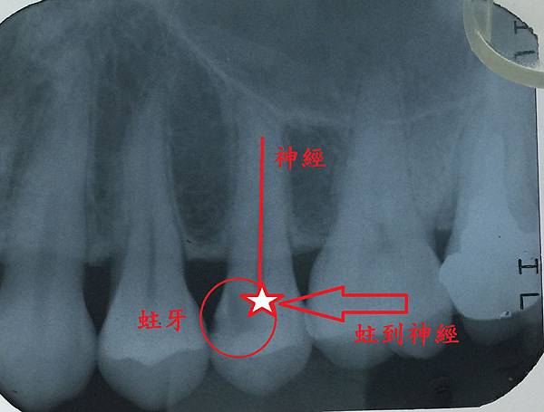 [蛀牙填補] 補蛀牙之前不會痛 為什麼補完反而會痛? 高雄牙