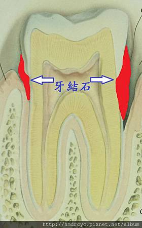 [牙周病洗牙]洗牙會傷牙齒嗎?高雄牙醫/牙周病洗牙推薦/高雄牙醫推薦