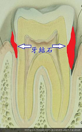 [牙周病洗牙] 洗牙會傷牙齒嗎? 高雄牙醫 牙周病洗牙推薦