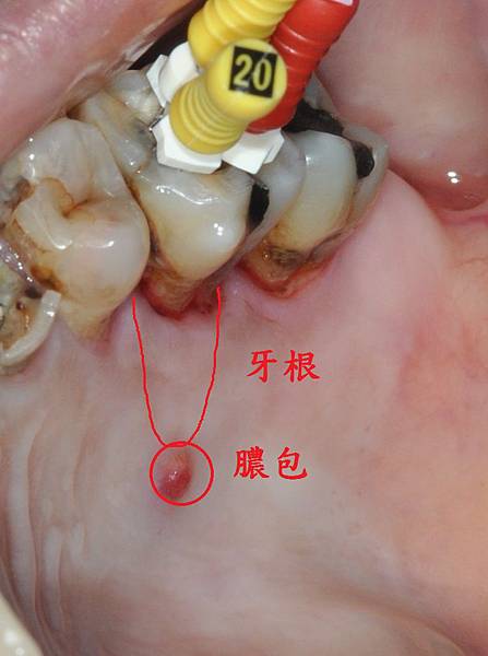 [根管治療] 神經已經抽掉了 怎麼還會痛呢? 高雄牙醫 根管