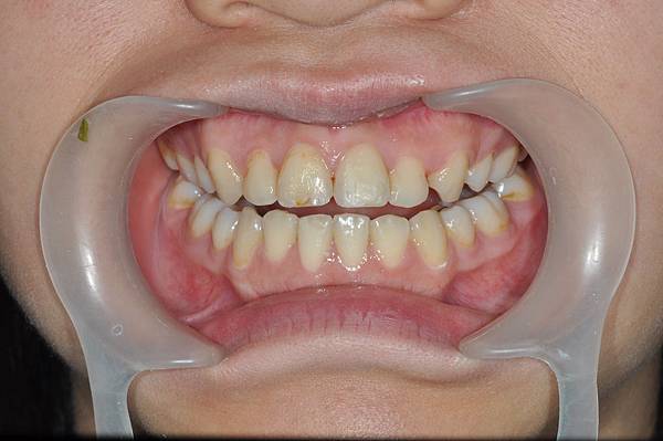 [蛀牙填補] 撞斷門牙 門牙斷掉 可以填補嗎? 高雄牙醫 蛀