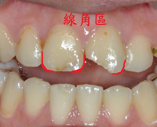 [蛀牙填補] 撞斷門牙 門牙斷掉 可以填補嗎? 高雄牙醫 蛀