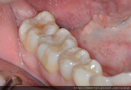 高雄牙醫/左營牙醫/牙醫推薦/高雄植牙 高雄牙醫/左營牙醫/牙醫推薦/高雄植牙