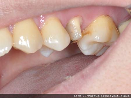 高雄牙醫/左營牙醫/牙醫推薦/高雄植牙