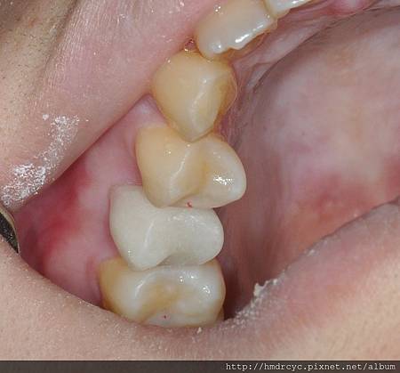 高雄牙醫/左營牙醫/牙醫推薦/高雄植牙