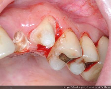 高雄牙醫/左營牙醫/牙醫推薦/高雄植牙
