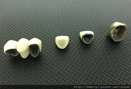 [假牙牙套] 假牙怎麼選擇 假牙材質 假牙價格 高雄牙醫 假