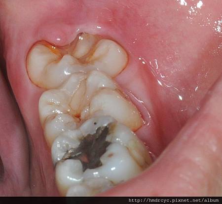 高雄牙醫/左營牙醫/牙醫推薦/高雄植牙 高雄牙醫/左營牙醫/牙醫推薦/高雄植牙