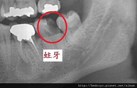 [拔牙手術] 一定要拔智齒嗎 智齒要不要拔 高雄牙醫 拔牙手