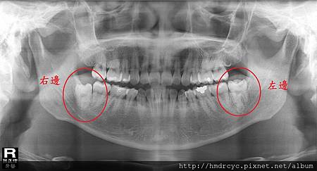 [拔牙手術] 一定要拔智齒嗎 智齒要不要拔 高雄牙醫 拔牙手