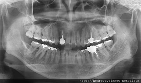 [拔牙手術] 一般拔牙治療 簡單拔牙 複雜拔牙 高雄牙醫 拔