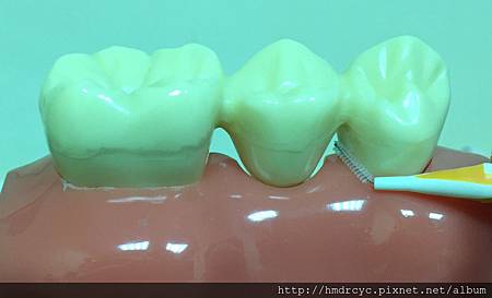 [假牙牙套] 牙橋下面怎麼清潔 假牙連結怎麼清潔 高雄牙醫 