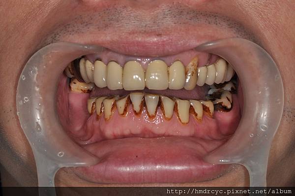 高雄牙醫/左營牙醫/牙醫推薦/高雄植牙 高雄牙醫/左營牙醫/牙醫推薦/高雄植牙