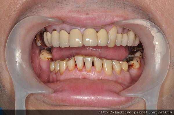 高雄牙醫/左營牙醫/牙醫推薦/高雄植牙 高雄牙醫/左營牙醫/牙醫推薦/高雄植牙