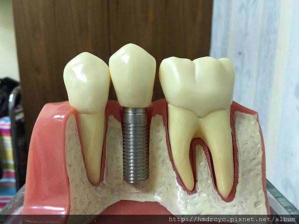 高雄牙醫/左營牙醫/牙醫推薦/高雄植牙 高雄牙醫/左營牙醫/牙醫推薦/高雄植牙