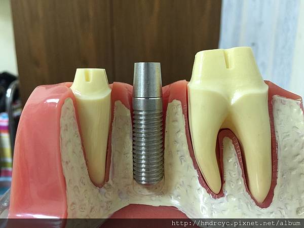 高雄牙醫/左營牙醫/牙醫推薦/高雄植牙 高雄牙醫/左營牙醫/牙醫推薦/高雄植牙