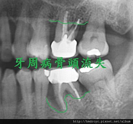 [拔牙手術] 牙齒是不是最好都保留? 牙齒最好不要拔? 高雄