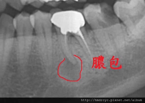 [根管治療] 抽神經放藥是甚麼意思? 放藥會不會痛? 高雄牙