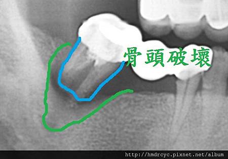[假牙牙套] 怎麼知道假牙裡面的牙齒有沒有問題 高雄牙醫 假