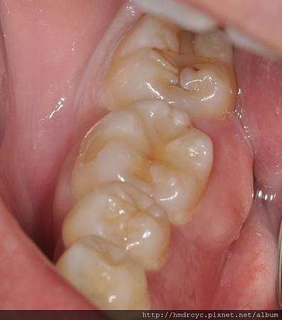 高雄牙醫/左營牙醫/牙醫推薦/高雄植牙 高雄牙醫/左營牙醫/牙醫推薦/高雄植牙