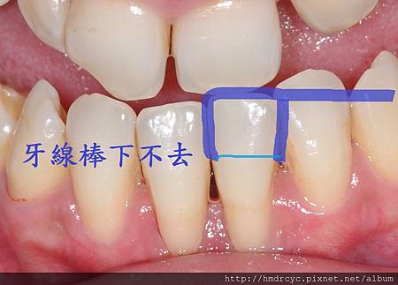 [牙周洗牙] 牙周病病友 怎麼選擇牙刷 牙膏 牙線 ?  高