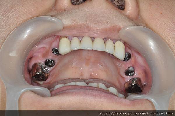 高雄牙醫/左營牙醫/牙醫推薦/高雄植牙 高雄牙醫/左營牙醫/牙醫推薦/高雄植牙