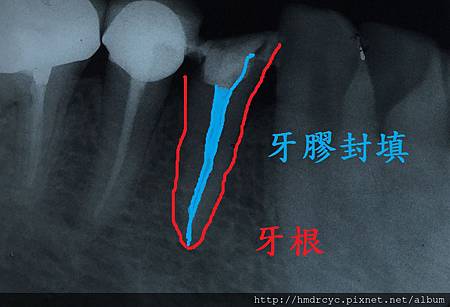 [根管治療] 根管治療的過程 抽神經的步驟 高雄牙醫 根管治