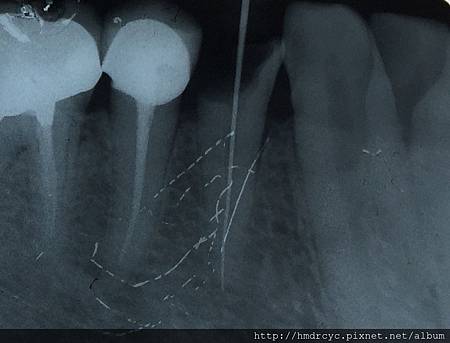[根管治療] 根管治療的過程 抽神經的步驟 高雄牙醫 根管治