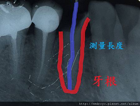 [根管治療] 根管治療的過程 抽神經的步驟 高雄牙醫 根管治