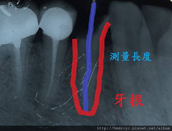 [根管治療] 抽神經會不會痛 根管治療會不會痛 高雄牙醫 根