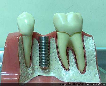 高雄牙醫/左營牙醫/牙醫推薦/高雄植牙 高雄牙醫/左營牙醫/牙醫推薦/高雄植牙