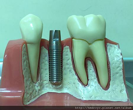 高雄牙醫/左營牙醫/牙醫推薦/高雄植牙 高雄牙醫/左營牙醫/牙醫推薦/高雄植牙