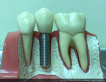 高雄牙醫/左營牙醫/牙醫推薦/高雄植牙 高雄牙醫/左營牙醫/牙醫推薦/高雄植牙