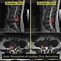 Resorption-of-lumbar-disc-herniation.jpg