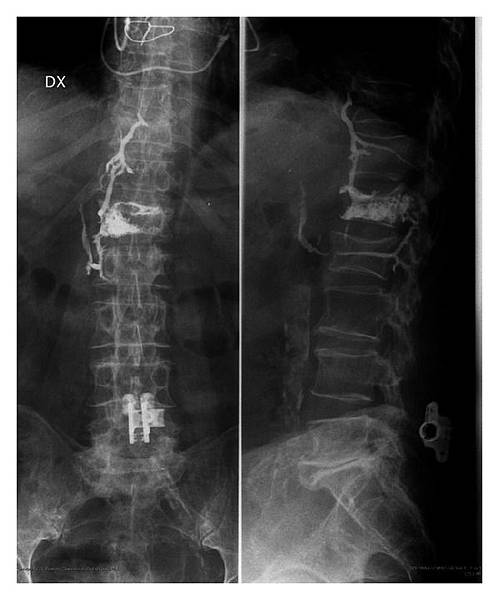 Cement-leakage-into-the-Batsons-paravertebral-venous-system.png