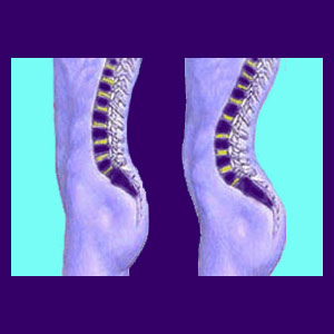 lordosis-1.jpg