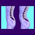 lordosis-1.jpg