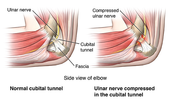 cubital tunnel syndrome.jpg