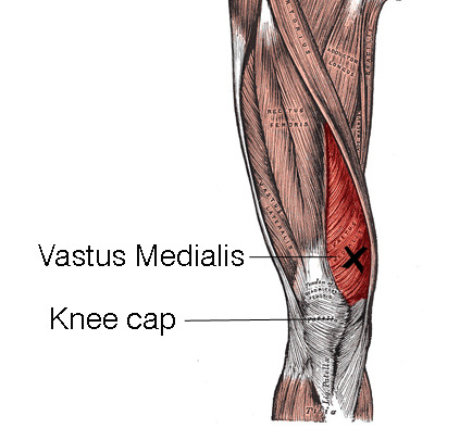 blog-vastus-med.jpg