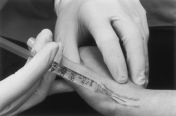 Injection of the first dorsal wrist extensor compartment for De Quveran.jpg