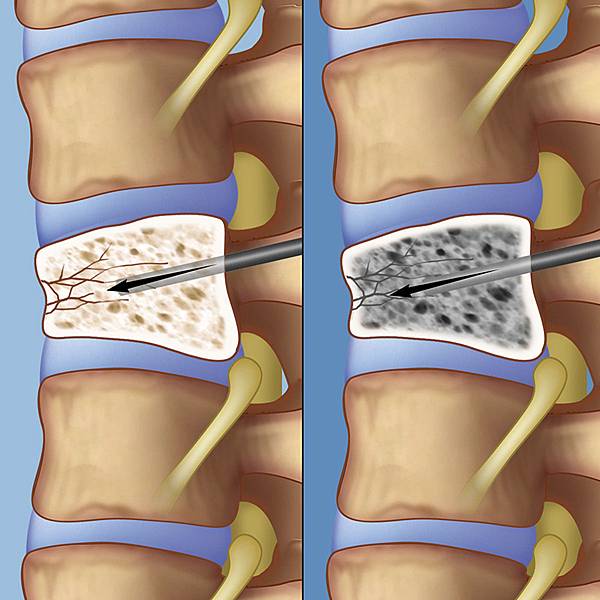 vertebroplasty-lg.jpg