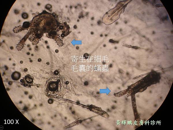 Demodex pixnet 4.jpg Demodex pixnet 4.jpg