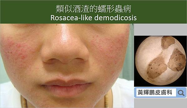 Demodex pixnet 7.jpg Demodex pixnet 7.jpg