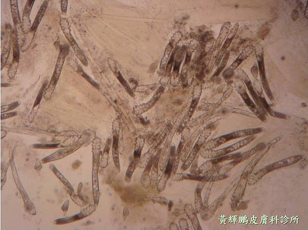 Demodex pixnet 8.jpg Demodex pixnet 8.jpg