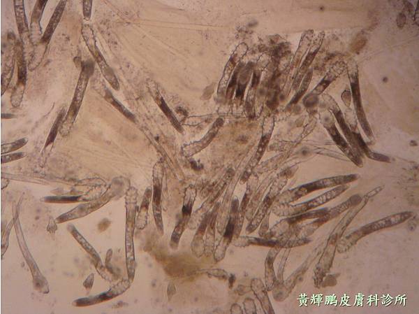 Demodex pixnet 8.jpg