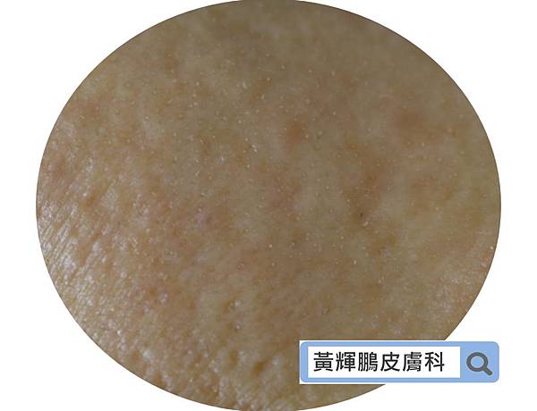 Demodex pixnet 12.jpg Demodex pixnet 12.jpg