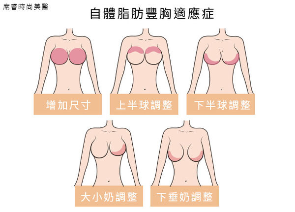 高雄席睿自體脂肪移植多少錢隆乳多少錢平價好不好黃金z波脂雕多少錢 (1) 高雄席睿自體脂肪移植多少錢隆乳多少錢平價好不好黃金z波脂雕多少錢 (1)