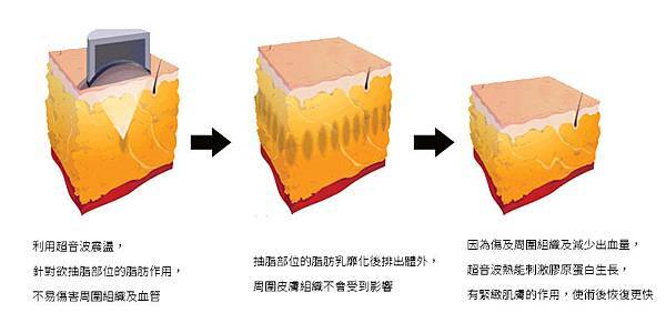 2抽脂費用抽脂價格抽脂手術超音波抽脂減肥塑身超音波抽脂推薦抽脂 推薦 大腿抽脂腹部抽脂黃金z波抽脂抽脂推薦席睿時尚美醫診所瘦身