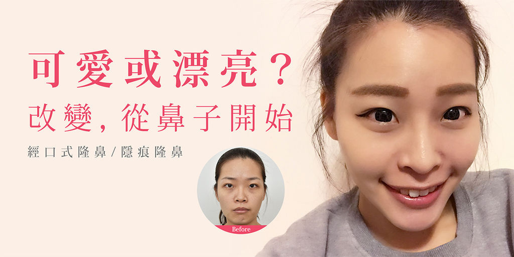高雄席睿時尚美醫經口式隆鼻隱痕隆鼻案例照片推薦王文禾醫生隆鼻手術案例分享 (9) 高雄席睿時尚美醫經口式隆鼻隱痕隆鼻案例照片推薦王文禾醫生隆鼻手術案例分享 (9)